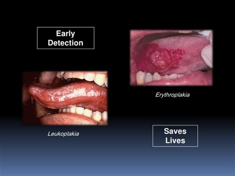 Oral Cancer Exam