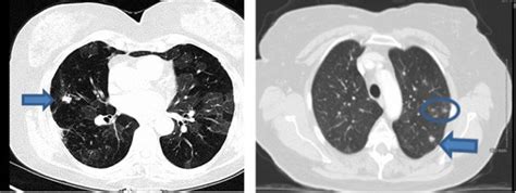 Ct Scan Of Chest Showing Right Lung Nodule Arrow On Left Panel And