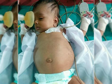 Surgeons Operating On Baby To Remove Tumour From Stomach Discover