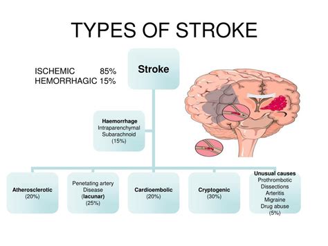 Ppt Management Of Stroke Powerpoint Presentation Free Download Id