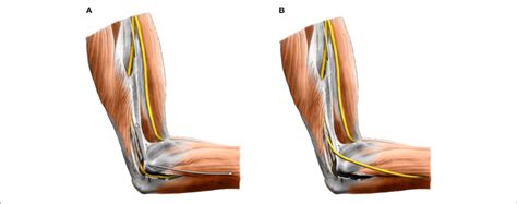 A In Situ Decompression Of The Ulnar Nerve In The Cubital Tunnel
