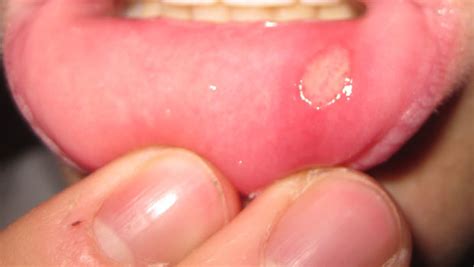 It affects the entire mouth including the tongue, gums, cheeks, and soft tissues in the mouth. Here's how successfully and naturally remove ulcers in the mouth, but also to promote prevention ...