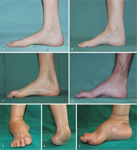 Recently more data are available on this . Charcot-Marie-Tooth disease