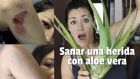 Sanar Una Herida De Manera Natural Aloe Vera Youtube
