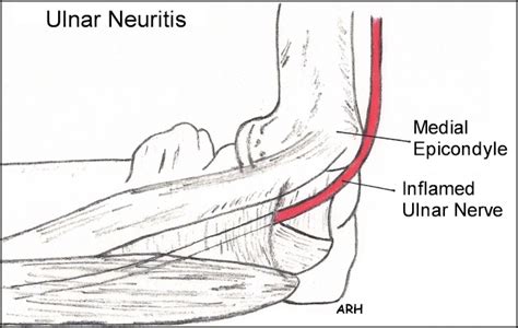 Repetitive Strain Injuries Rsi Carpal Tunnel Syndrome Symptoms