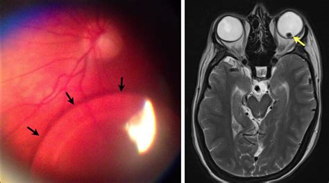Ectopia Lentis In Marfans Syndrome Causing Positional Visual Symptoms