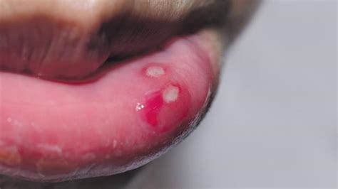 Irritating Mouth Ulcers