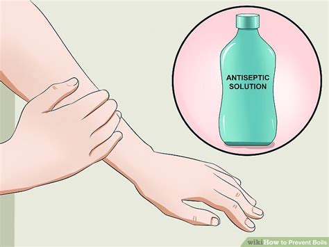 6 Ways To Prevent Boils Wikihow