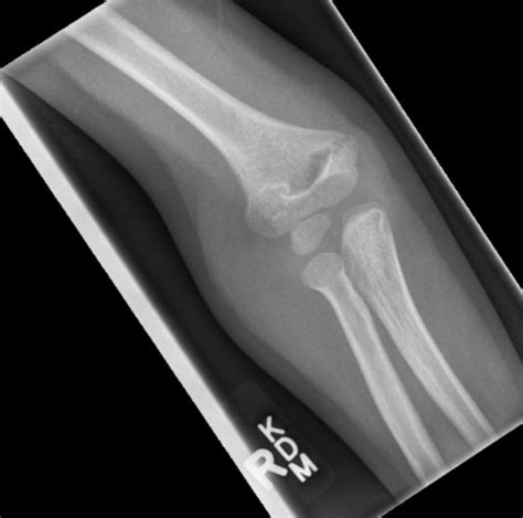 Elbow Fractures Undergraduate Diagnostic Imaging Fundamentals
