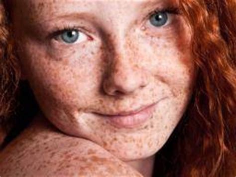 Why Do Redheads Get Melanoma More Frequently