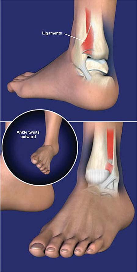High Ankle Sprain Syndesmosis Ligament Injury Central Coast