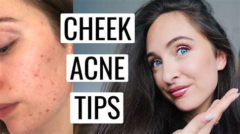 Tips To Get Rid Of Acne On Your Cheeks 💡 Youtube