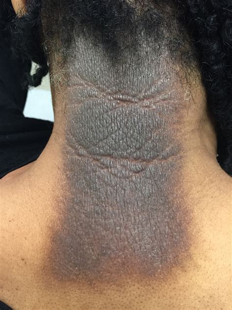 Seborrheic Dermatitis Of The Face And Scalp In Skin Of 43 Off