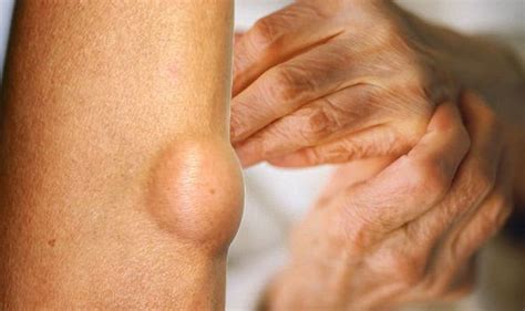 Rheumatoid Arthritis Nodules Are A Symptom Uk