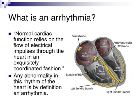 Ppt The Befores And Afters Of Arrhythmias And Hypertrophic