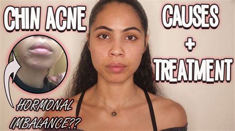 Chin Acne Causes Why Youre Getting It And How To Prevent It Naturally