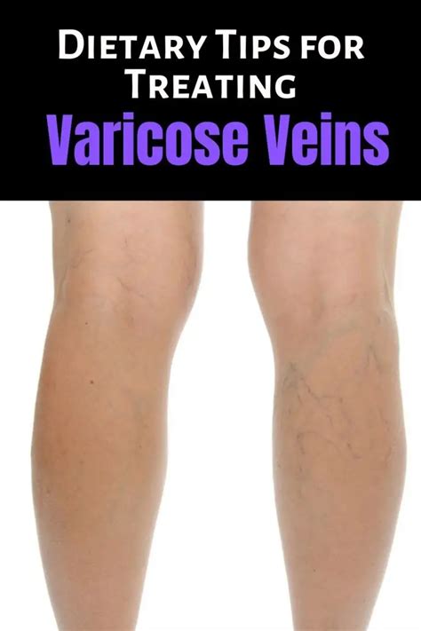 Dietary Tips For Treating Varicose Veins Faster Diy Active