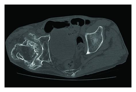 Ct Imaging Around The Hip Showing Marked Gluteus Muscle Atrophy