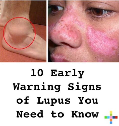 Early Warning Signs Of Lupus You Need To Know Signs Of Lupus