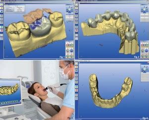 Para que sirve un CAD CAM Odontológico Guia Dental Ecuatoriana