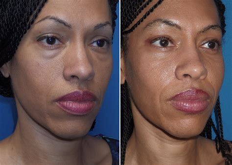 Cheek Implants Gallery Richmond Va Cosmetic Facial Surgery