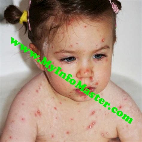 What Is Skin Infection 2 Different Types Of Skin Infection Info