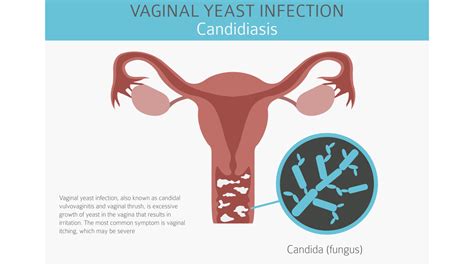 Yeast Infection Discharge Cottage Cheese