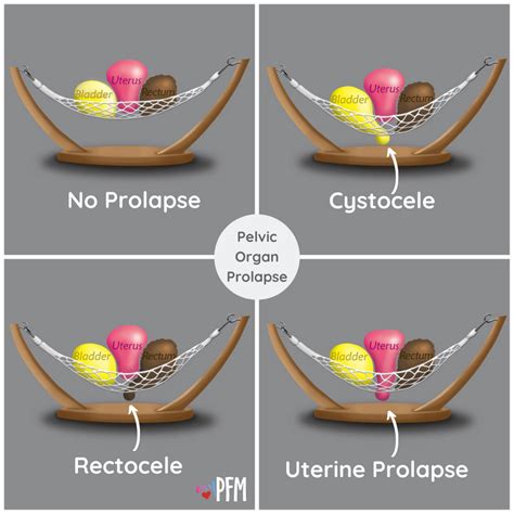 Pelvic Organ Prolapse Pop