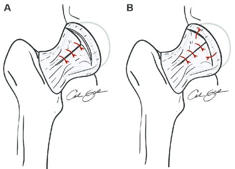 Schematic Of A Partial Capsular Closure And B Complete Capsular