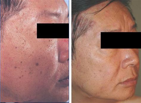 Old Age Spots On Face Aimees Skin Care Solutions Age Spots On Face