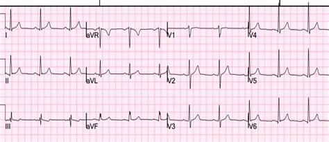 Dr Smiths Ecg Blog Precordial St Depression What Is The Diagnosis