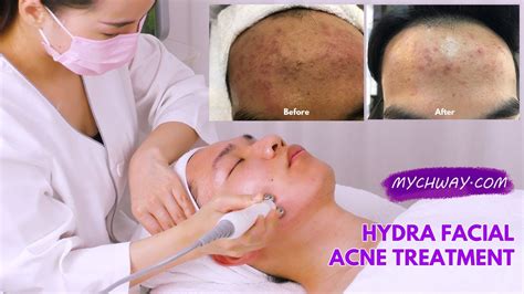 Hydrafacial Glowing Skin Before And After Hydra Facial Full Operation