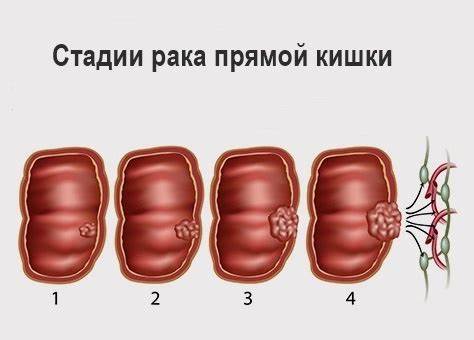 Диета онкология прямой кишки
