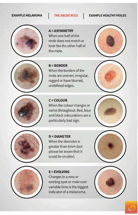 The Abcde Rule Of Moles •following My Short Course On Melanoma And Skin
