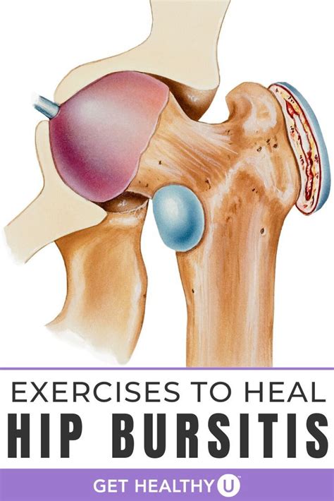 Best Exercises For Hip Bursitis Video Included Artofit