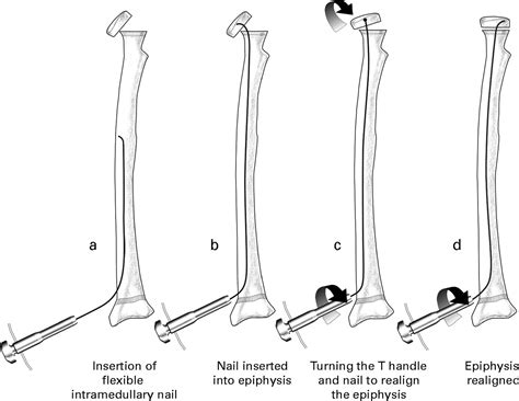 Elastic Stable Intramedullary Nail Fixation For Severely Displaced