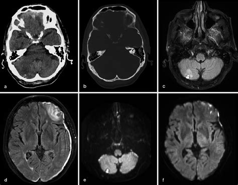 Hemorrhagic Coup And Contre Coup Lesions In A 73 Year Old Man A