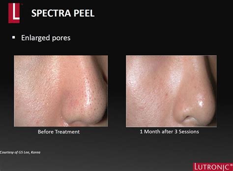 Hollywood Spectra Carbon Peel Surface Clinic