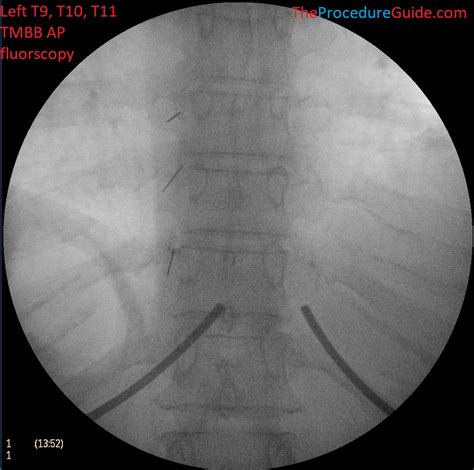 Fluoroscopic Guided Thoracic Medial Branch Block Technique And