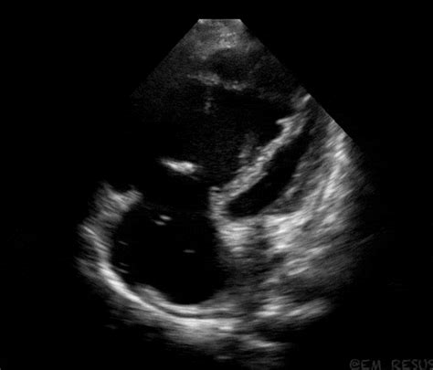Tricuspid Valve Endocarditis On Pocus This Is The Grepmed