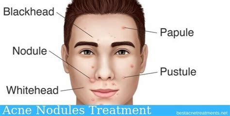 Get Nodular Acne Treatment  Acne Problems