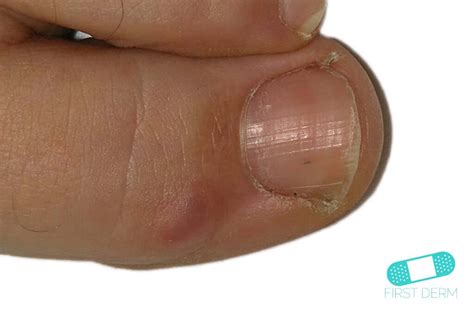 Cyst Near Fingernail Bed Nail Ftempo