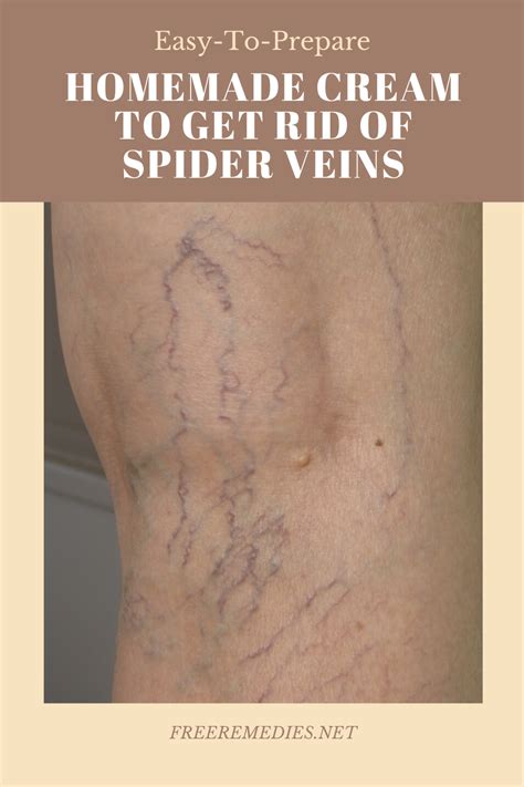 Easy To Prepare Homemade Cream To Get Rid Of Spider Veins In 2020 Spider Veins Get Rid Of