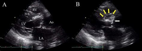 Preoperative Tte Parasternal Long Axis View Showing Vegetation On The