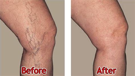Varicose Veins Laser Treatment Before And After