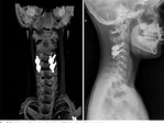 Figure 4 from C3-C4 Unilateral Facet Fracture Dislocation with ...
