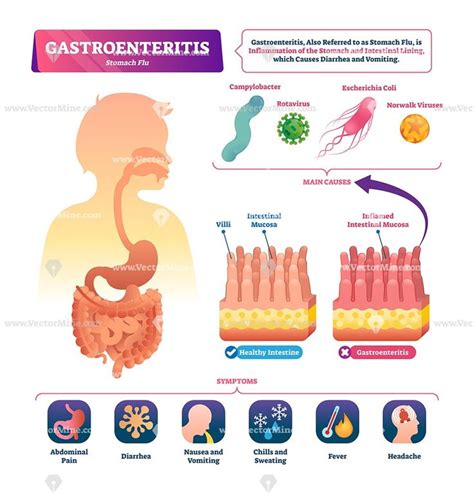 Gastroenteritis Vector Illustration Vectormine Gastroenteritis