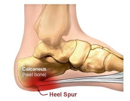 It is important however to understand that these spurs. How you can easily resolve your heel spurs