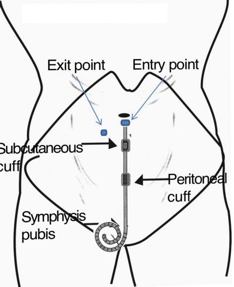 Techniques For Peritoneal Dialysis Catheter Placement Intechopen My