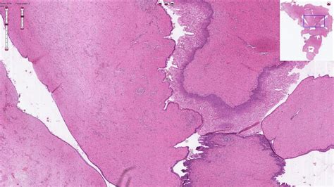 Vulvar Cysts Humpathcom Human Pathology